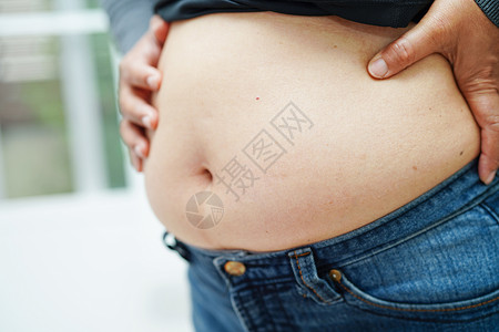 橘皮组织亚裔女性在办公室显示胖肚子大超重和肥胖症肌肉展示外科尺寸腰部工作手术烧伤塑料肥胖背景