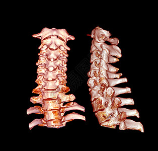 CT 子宫颈脊椎3D剖析 SCAN颈椎病人扫描椎骨射线骨科疼痛伤害诊断颈部背景图片