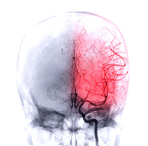 脑动脉脑血管造影学血块放射科诊断医院病人解剖学小动脉治疗荧光镜系统背景
