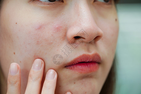 瘢痕疙瘩皮肤脸部的骨灰和伤疤 塞巴塞氏腺紊乱 少女皮肤护理美容问题皮脂腺药品前额青春期女孩毛孔化妆品产品肤色治疗背景