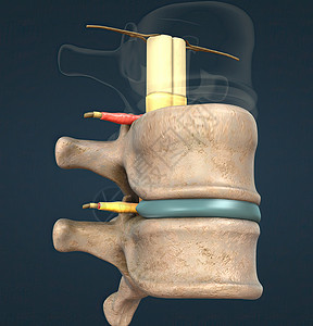 脊椎神经是一种混合的神经 在脊髓与身体之间带有运动 感官和自动信号 a 脑内腰椎病人运动机磁盘治疗整骨压力姿势绳索风湿病图片