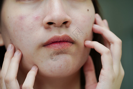 红色化妆品皮肤脸部的骨灰和伤疤 塞巴塞氏腺紊乱 少女皮肤护理美容问题青少年产品女孩感染皮肤科瘢痕缺陷青春期化妆品前额背景