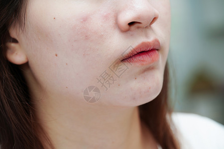 女孩脸皮肤脸部的骨灰和伤疤 塞巴塞氏腺紊乱 少女皮肤护理美容问题前额产品毛孔疾病卫生药品瘢痕化妆品女性青春期背景