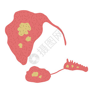 溪中石块血清腺中石块的矢量图 Sialolith病设计图片