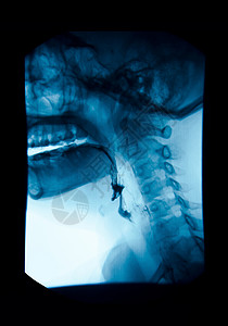 X射线高肠胃肠 UGI Esophagram x光 医师图片