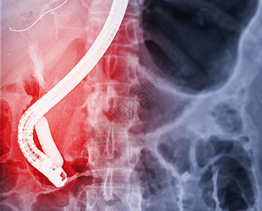 医生在现代手术室内进行 ERCP 和腹腔镜胆囊切除术后的内窥镜 X 射线图像图片