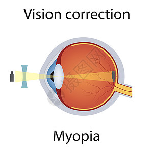 近视视力矫正图解。视力障碍图片