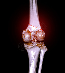 膝关节 CT 扫描 3D 渲染图像显示远端股骨骨折图片