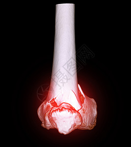 膝关节 CT 扫描 3D 渲染图像显示远端股骨骨折图片