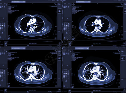 CTA 肺动脉 3D 渲染显示肺动脉分支图片