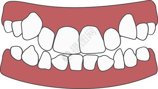 正畸问题牙齿拥挤 异常爆发 相反咬合、开咬、牙齿拥挤、蛀牙、牙列 孤立的矢量图图片