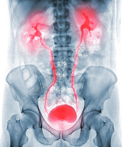 静脉肾盂造影或IVP是注射造影剂后对泌尿道进行的X射线检查图片