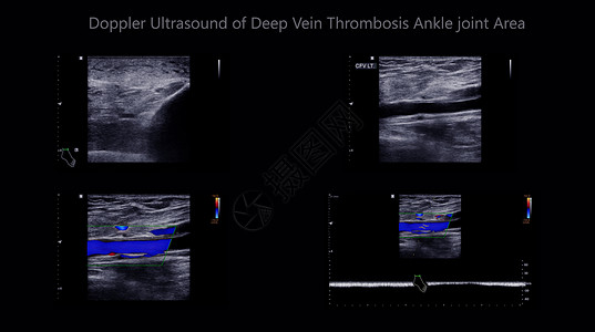 彩色多普勒超声检查对下肢深静脉血栓形成患者有无发现下肢深静脉血栓的作用图片