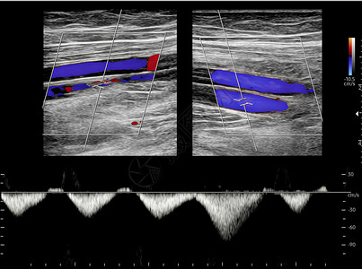 彩色多普勒超声检查对下肢深静脉血栓形成患者有无发现下肢深静脉血栓的作用图片