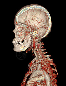 CTA 脑和颈动脉或脑 CT 血管造影 3D 渲染图像图片