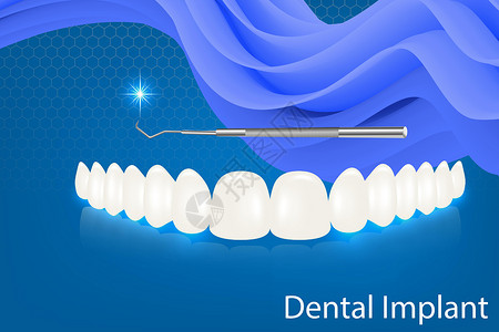 人类牙齿和牙种植体矢量插图图片