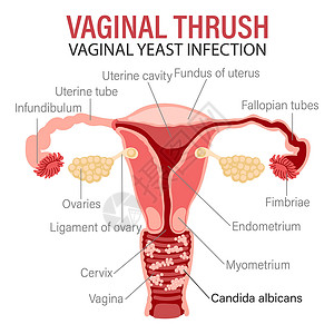 女性生殖系统疾病、外阴阴道念珠菌病或阴道酵母菌感染图片