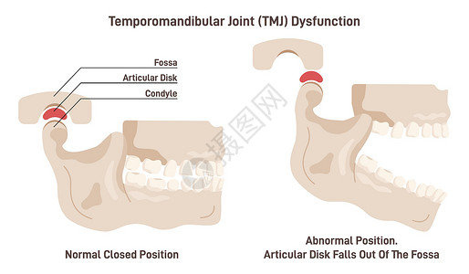 颞下颌关节紊乱症或 TMJ。影响图片