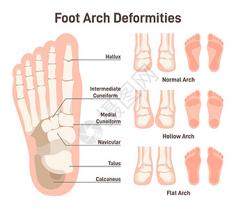 足部解剖图。空心和扁平足弓畸形。正常足弓图图片
