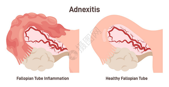 输卵管炎或附件炎。输卵管感染和炎症图片