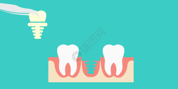 种植手术拔除坏掉牙齿插画GIF高清图片