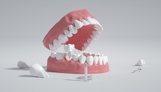 口腔种植牙牙齿模型设计图片