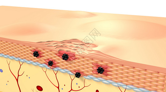 皮层组织皮肤病变场景设计图片