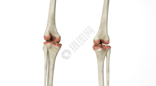 人体四肢骨骼病变场景设计图片