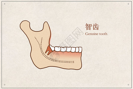 口腔解剖阻生智齿医疗插画示意图插画