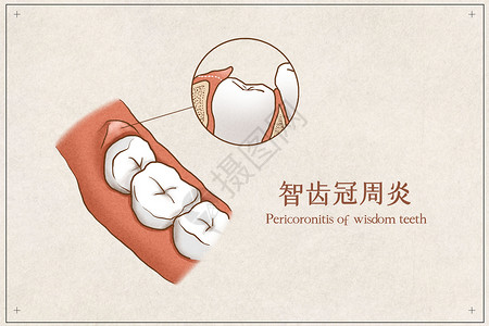 牙龈痛智齿冠周炎医疗插画示意图插画