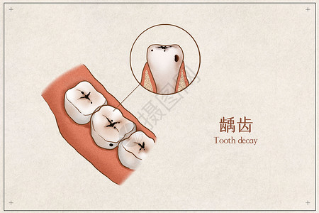 病女照片素材龋齿医疗插画示意图插画