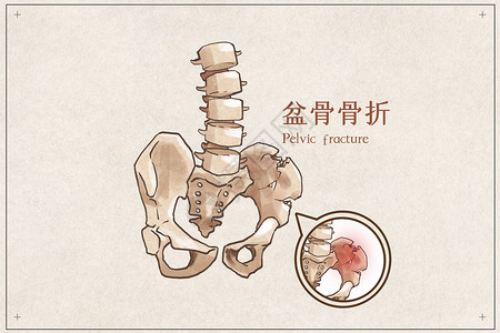 盆骨前倾盆骨骨折示意图插画