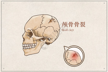 颅骨骨裂示意图插画