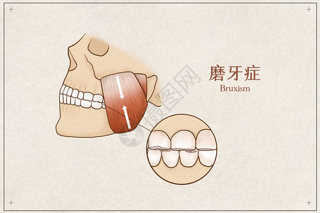 磨牙症医疗插画示意图高清图片