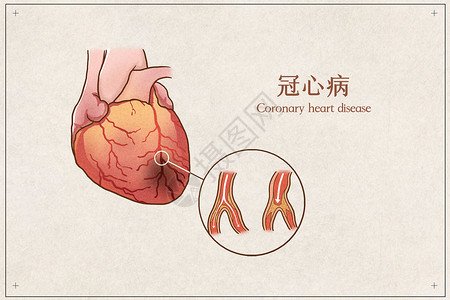 冠状动脉粥样硬化性心脏病冠心病医疗插画示意图插画