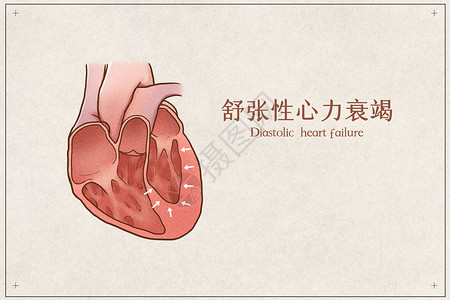 心脏衰竭舒张性心力衰竭医疗插画示意图插画