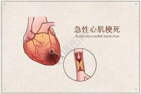 心脏病研究急性心肌梗死医疗插画示意图插画