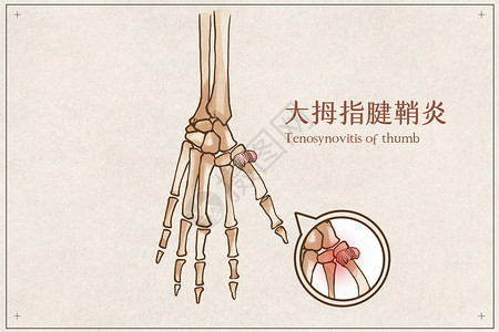 人骨大拇指腱鞘炎示意图插画