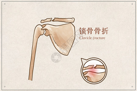 跌打肿痛锁骨骨折示意图插画