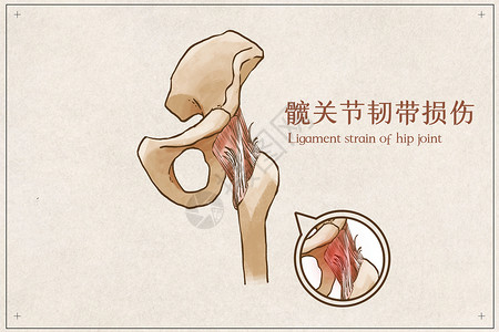 骨外科髋关节韧带损伤示意图插画