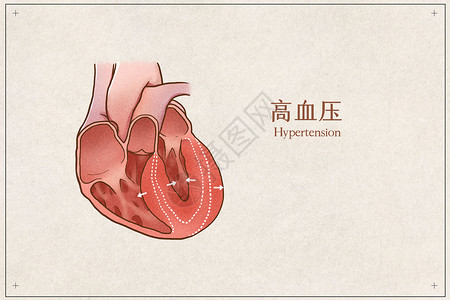 高血压心脏病高血压医疗插画示意图插画