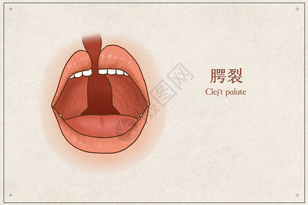 张开的嘴巴腭裂医疗插画示意图插画