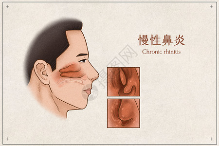 慢性鼻炎医疗插画示意图背景图片