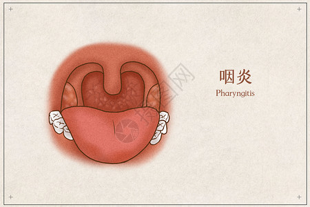 慢性的咽炎医疗插画示意图插画