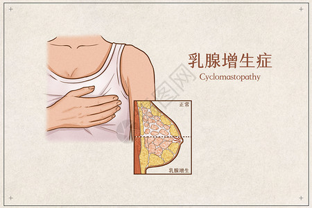 女性乳房乳腺增生症医疗插画示意图插画