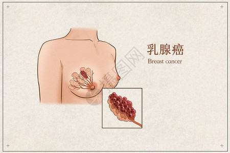 胸部检测乳腺癌医疗插画示意图插画