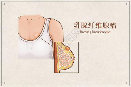 胸部胀痛乳腺纤维腺瘤医疗插画示意图插画
