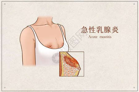 女人胸部急性乳腺炎医疗插画示意图插画
