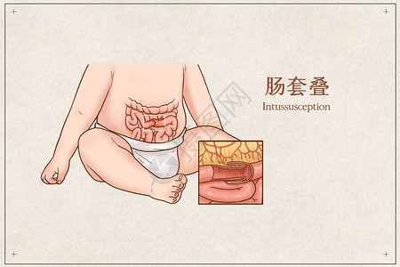 肠套叠医疗插画背景图片
