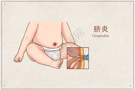 婴儿肚脐脐炎医疗插画插画